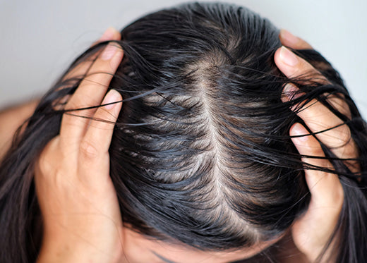 How To Prevent Oily Scalp With These 5 Tips